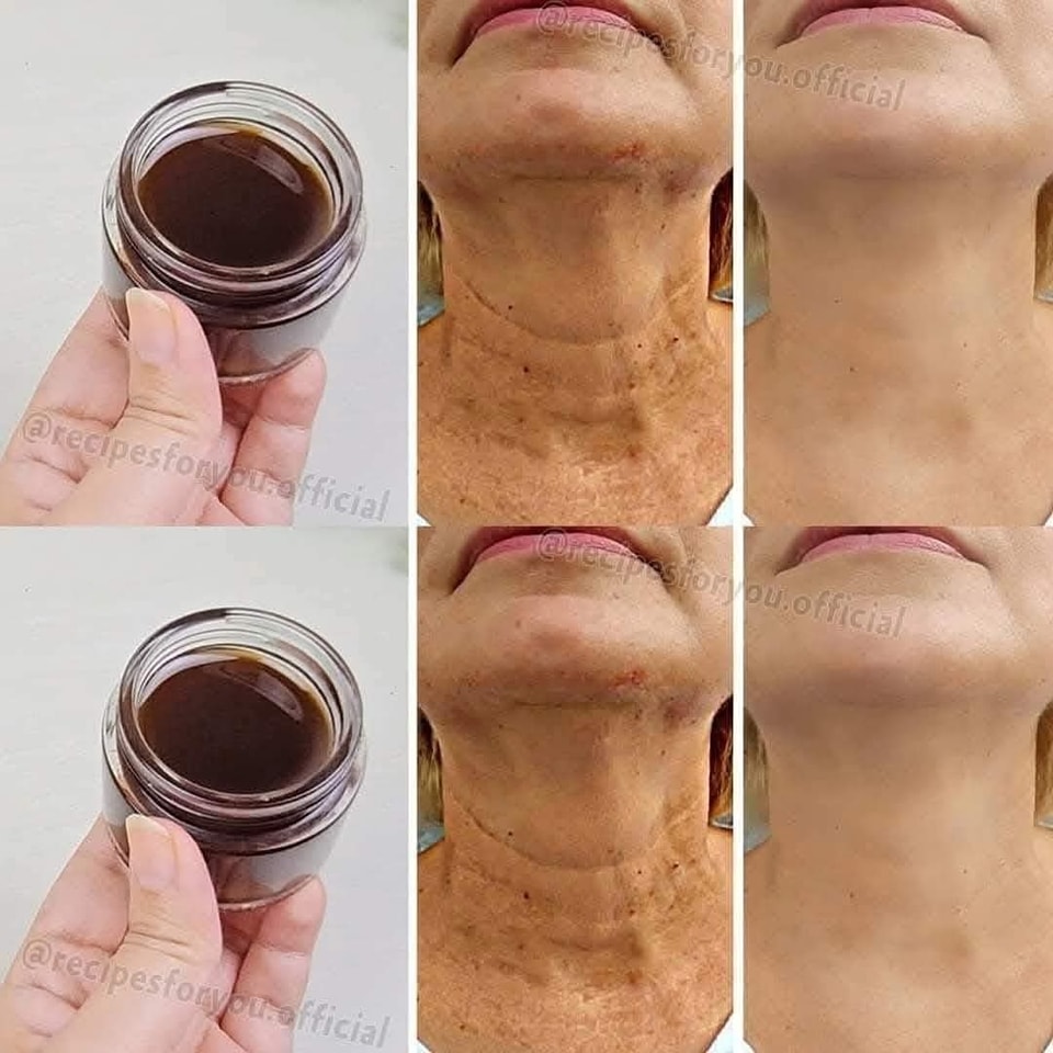 Anti-Aging Magic Oil: Coffee Oil That Erases Wrinkles and Is Stronger than Botox