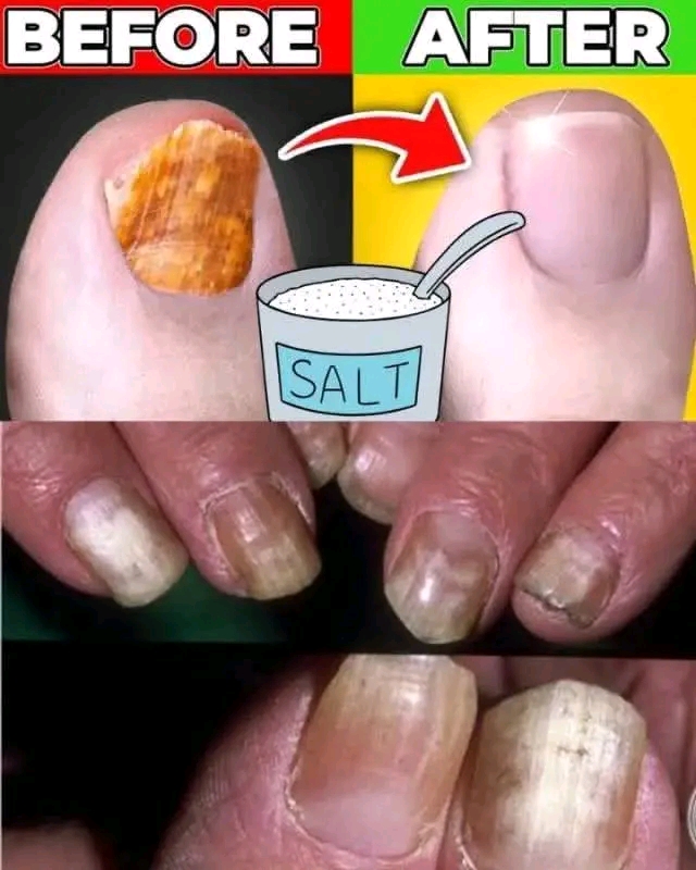 Eliminate Nail Fungus Naturally: A Simple and Effective Remedy with Baking Soda, Vinegar, and Tea Tree Oil