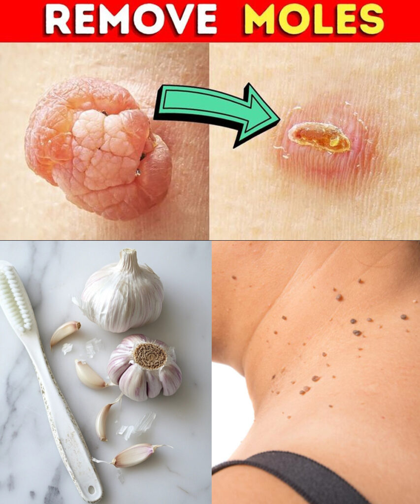 Plantar Warts and Skin Tags Disappear Naturally—Try This Overnight Remedy