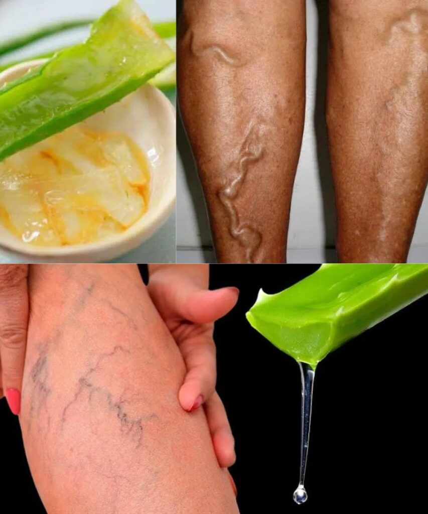 How to eliminate varicose veins and soothe heavy legs with Aloe Vera