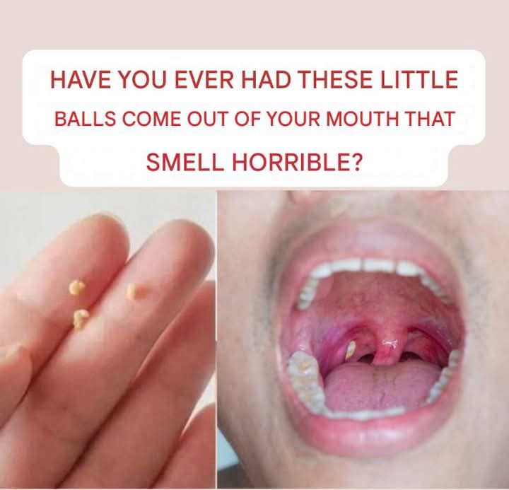CAUSES OF WHITE OR YELLOW BALLS ON THE TONSILS