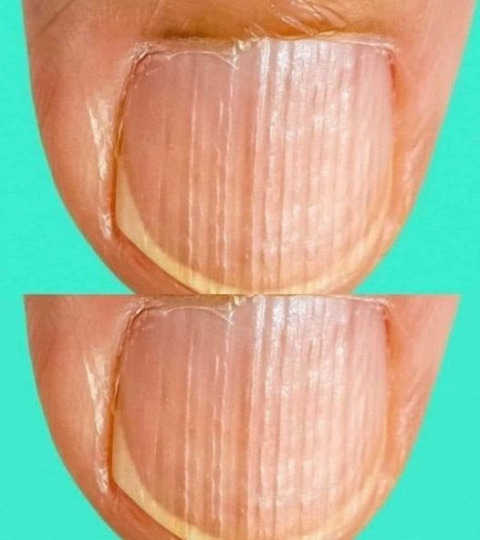 Doctor Explains What It Means If You Have Ridges On Your Fingernails