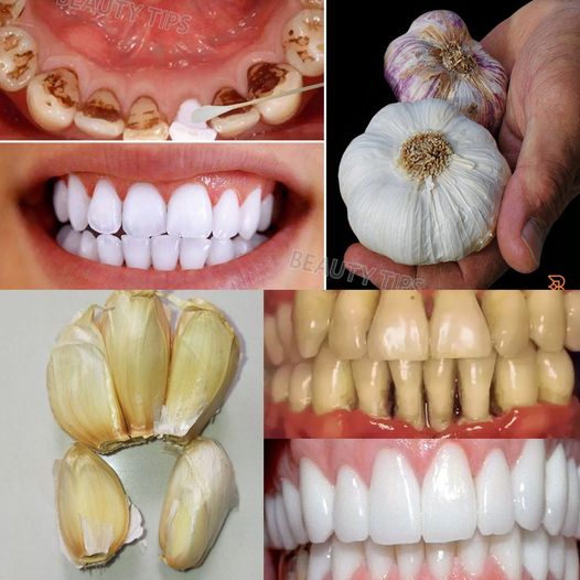 Natural Oral Health Boost with Garlic
