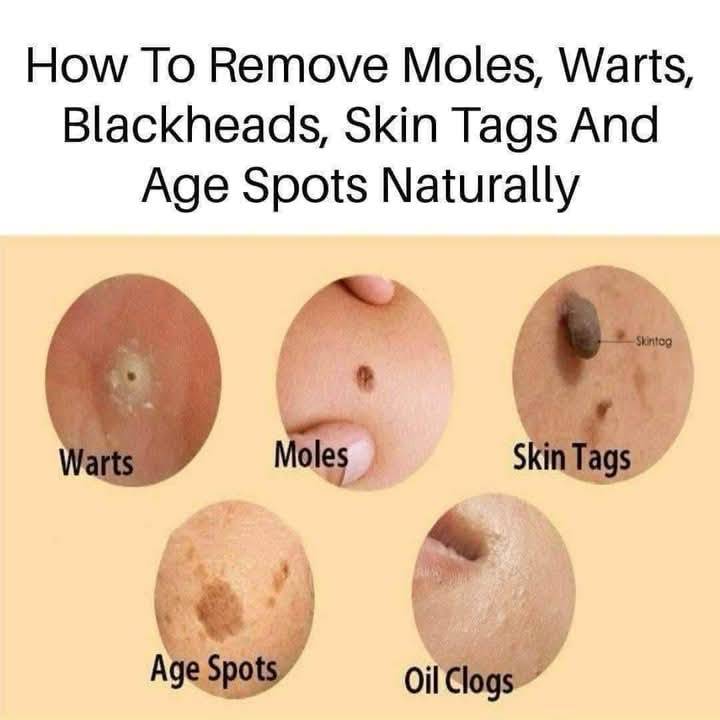 Say Goodbye to Calluses with This Natural Remedy