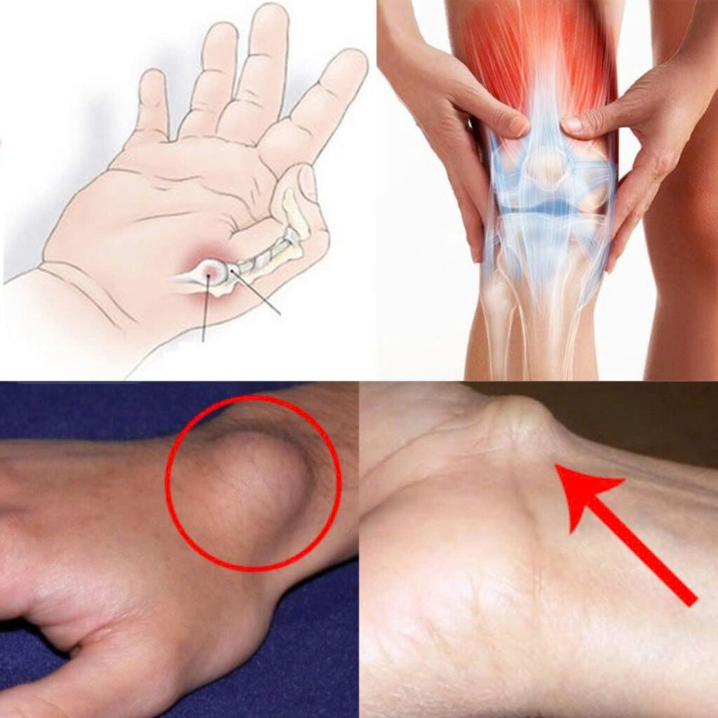 A cyst on the foot or wrist: what should you do?