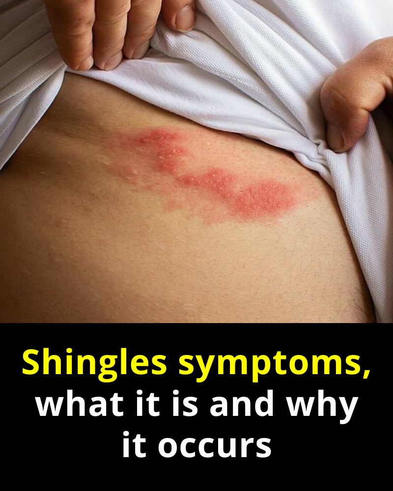Everything You Need to Know About Shingles: Causes, Early Detection, and Natural Treatments