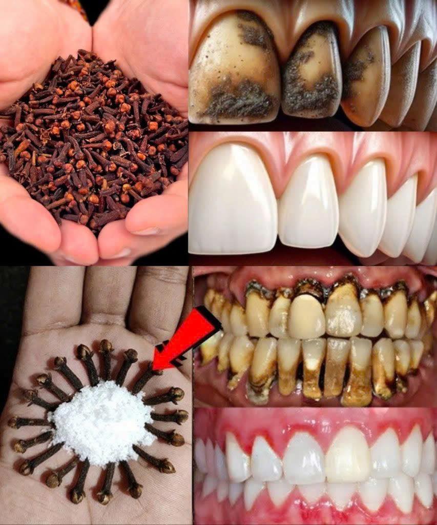 Chewing cloves daily: A holistic approach to oral health