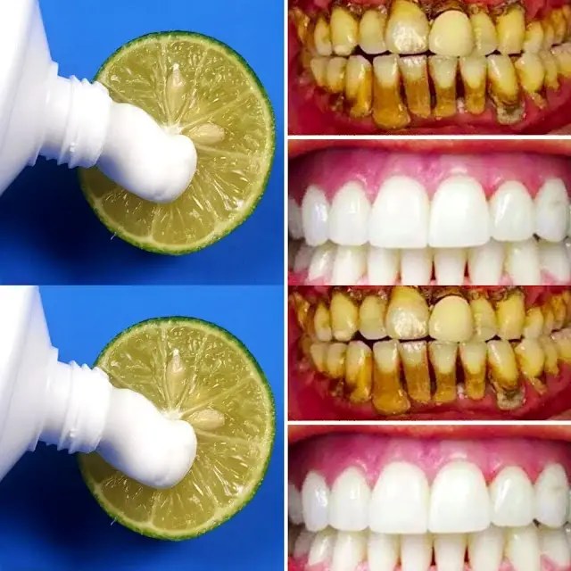 A naturally dazzling smile: whiten your teeth with lemon in 2 minutes
