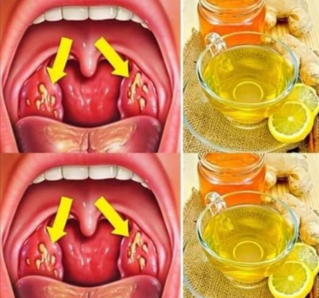 Natural Remedies for Tonsillitis: Soothe Your Throat and Find Relief