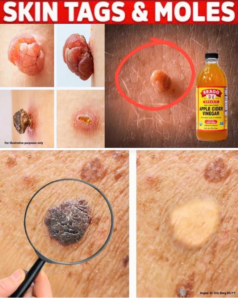 Plantar warts and skin tags can disappear naturally. Try this overnight remedy to see results