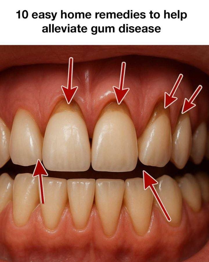 10 Easy Home Remedies To Help Alleviate Gum Disease