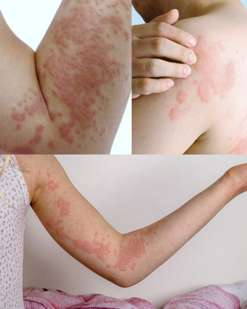 Her whole body itched: what she thought was a simple allergy was hiding something else.