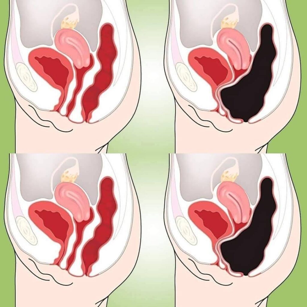 How to Cleanse Your Colon Naturally at Home (Colon Cleanse Smoothie)