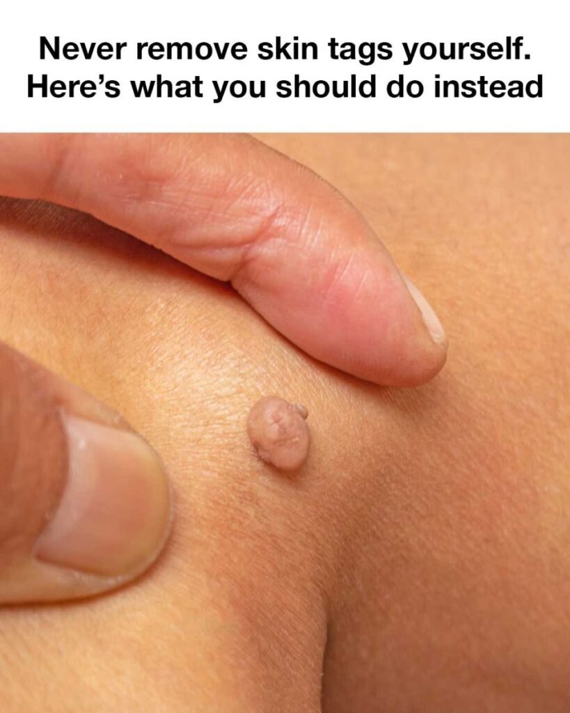 Never remove skin tags yourself. Here's what you should do instead