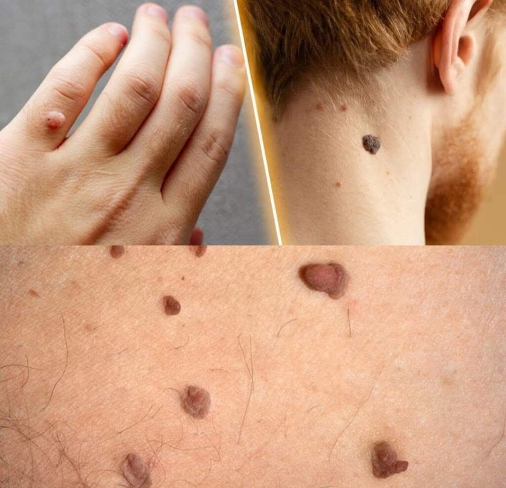 How to Remove Skin Tags and Warts Overnight: Safe and Effective Methods