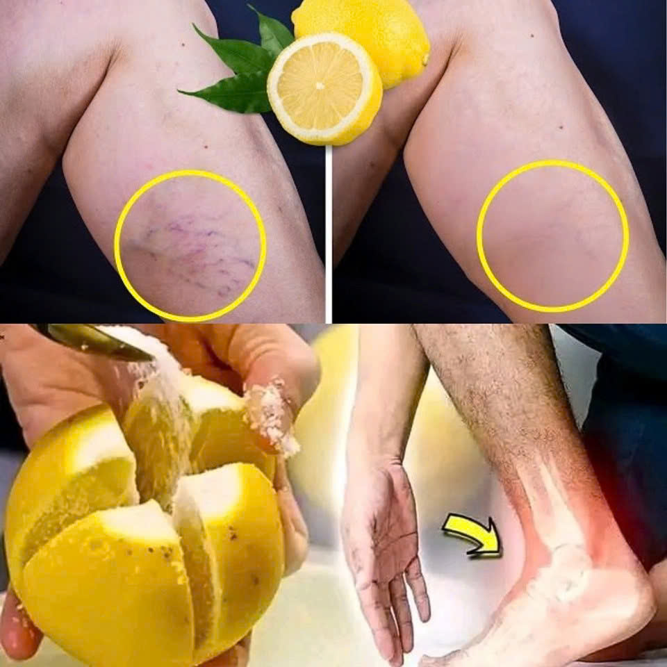 Mom’s Natural Remedy with Lemon: Cure-All for Leg Pain, Rheumatism, Varicose Veins, Arthritis, Headaches, and Joint Pain