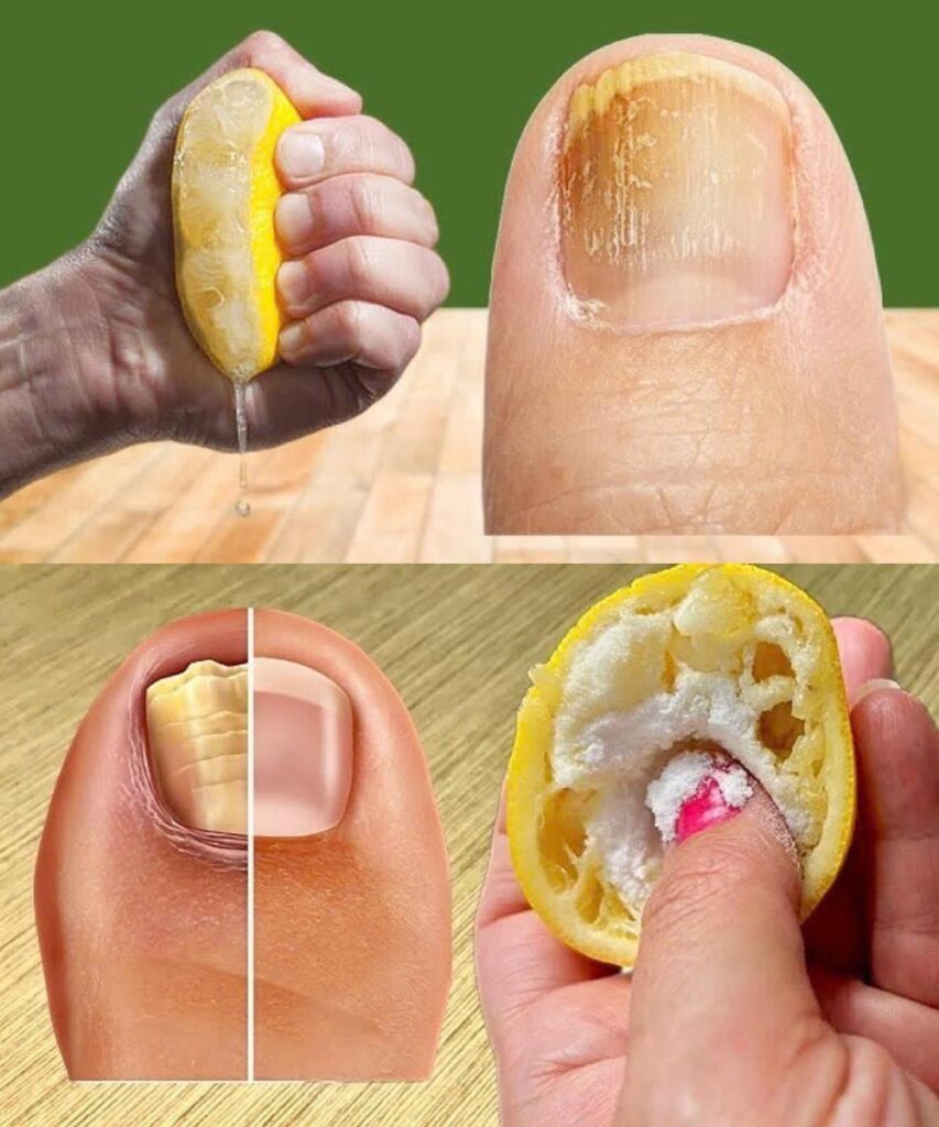 Say goodbye to stubborn toenail fungus with this natural remedy