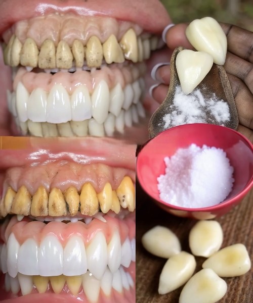 Garlic and Baking Soda for Teeth: Natural Remedy for Healthy and Bright Smiles