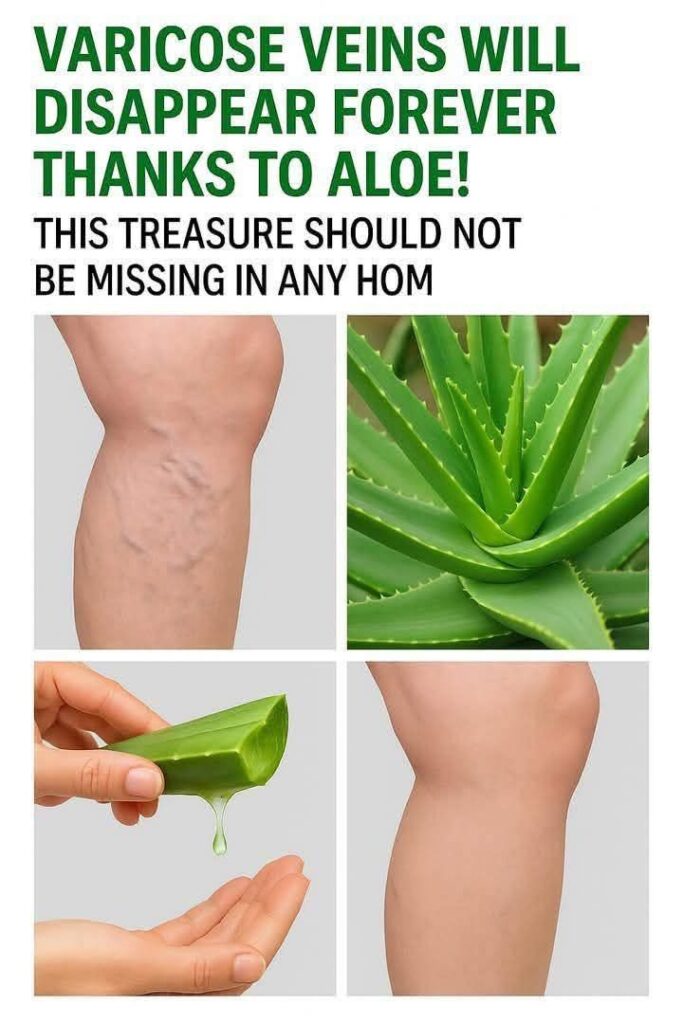 Aloe Vera: A Gentle Solution for Varicose Veins