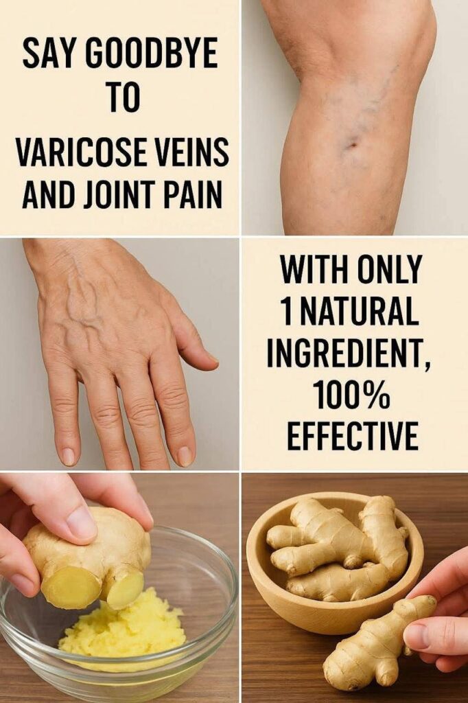 Say Goodbye to Varicose Veins & Joint Pain with Just 1 Natural Ingredient – Ginger!