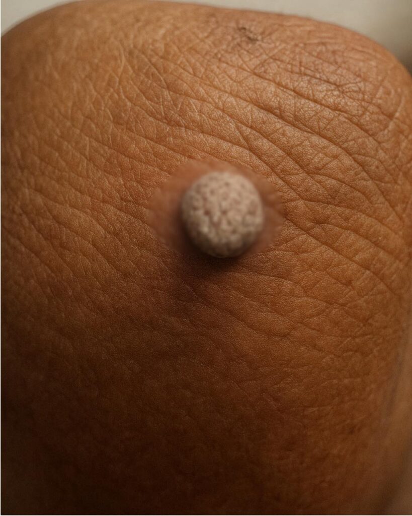 Ugh, got a crusty looking bump on my elbow. Can I remove this myself at home, or do I need to see a doc? Looks so bad