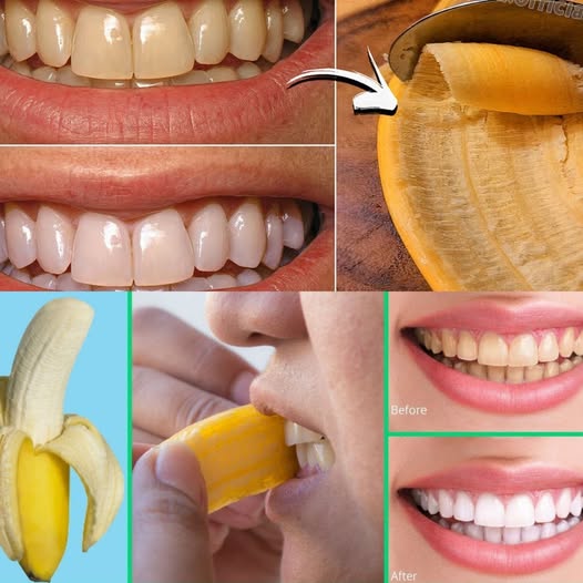 Discover the Secret: Easy & Effective Teeth Whitening with Banana Peels!