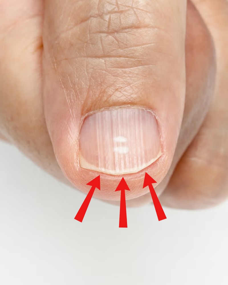 If you have these lines on your nails after 40, it is a clear sign that..