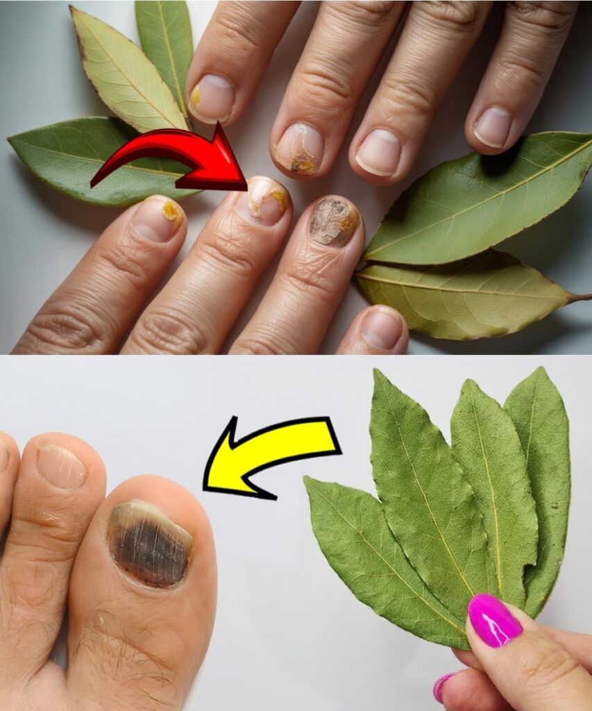 Say Goodbye to Nail Fungus for Less Than $0.50! A Simple Bay Leaf Remedy That Works