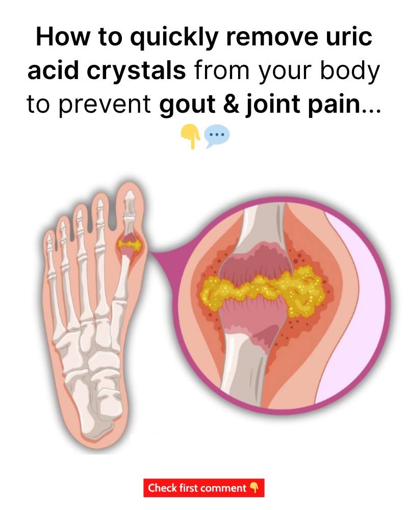 How To Quickly Remove Uric Acid Crystals From Your Body To Prevent Gout And Joint Pain