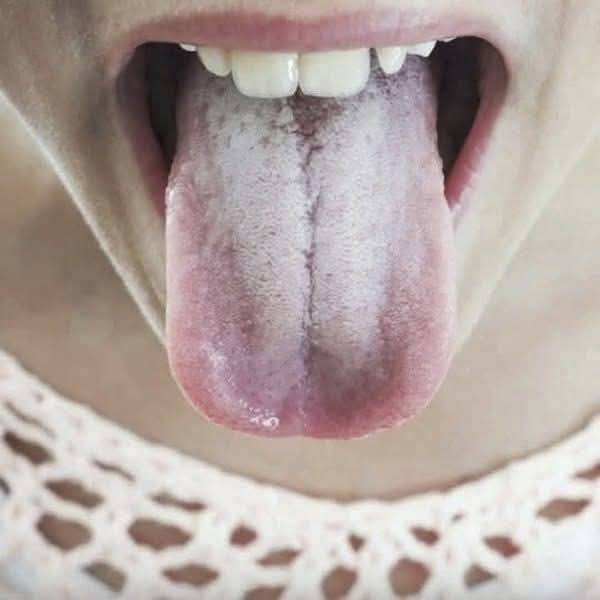 Understanding the Causes of a White Tongue: What Your Tongue May Be Telling You