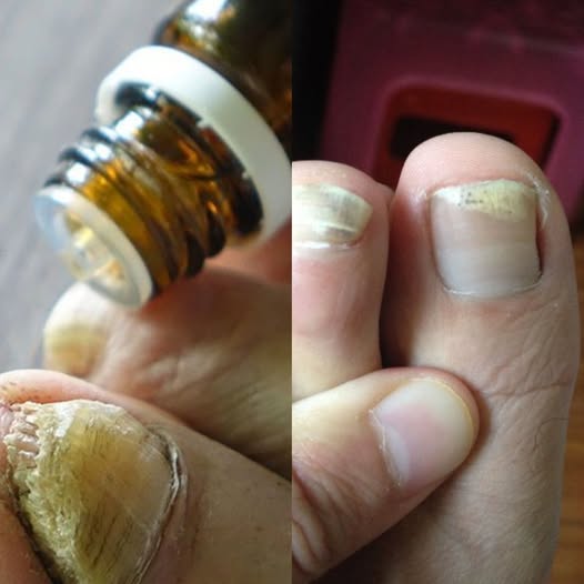 Discover the Miracle Solution That Permanently Kills Toenail Fungus! 