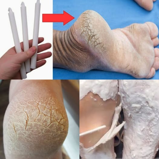Soften, Heal, and Restore Your Feet Overnight with Candle Wax