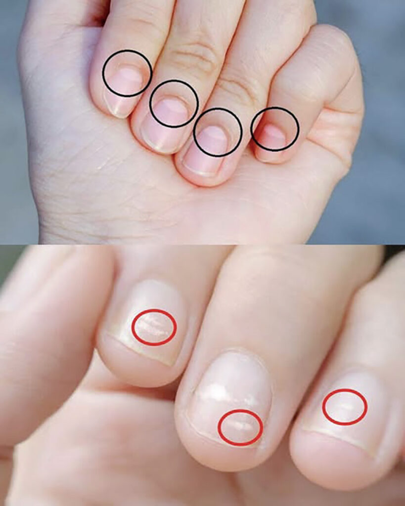 Half-moons on nails reveal our health status