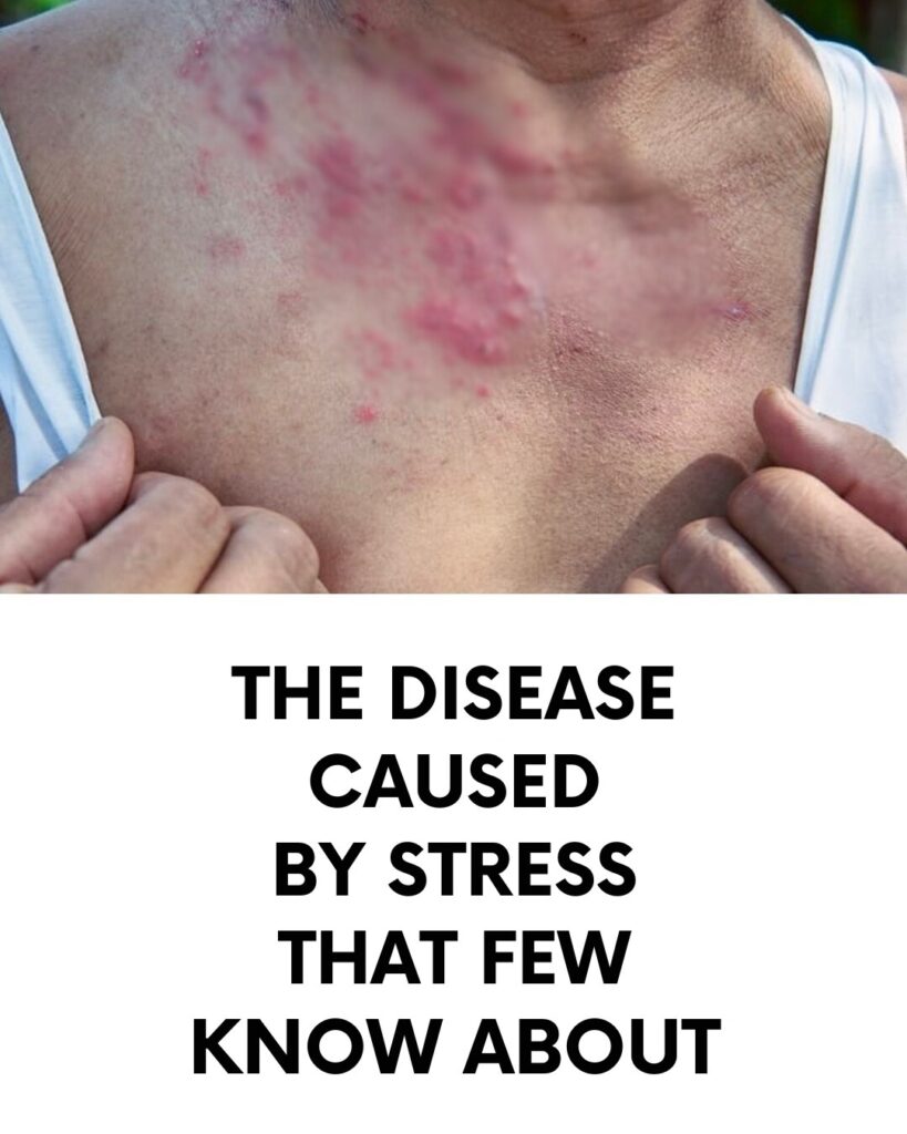 The disease caused by stress that few know about
