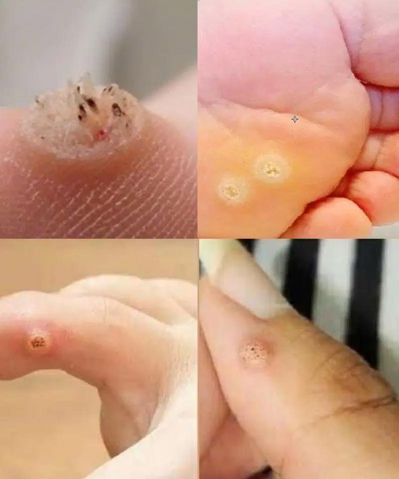 Wa.rning Sign: This Type of Skin Growth May Signal a Serious Issue