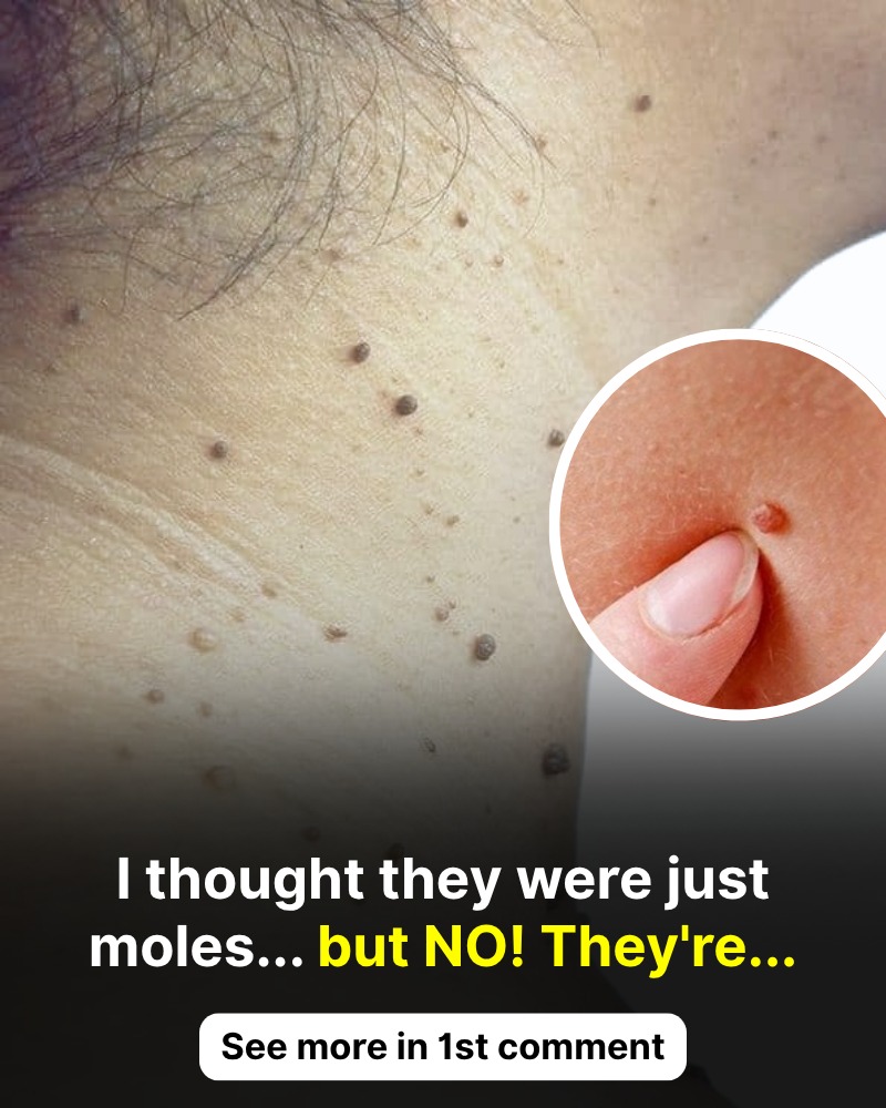 What are fibropapillomas and why do they appear on the skin?