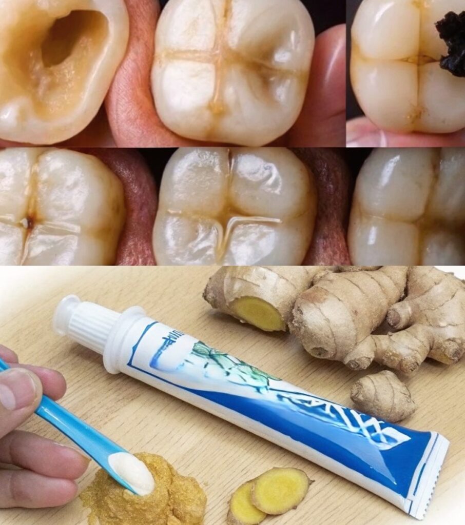 How to Naturally Repair a Cavity and Strengthen Your Teeth