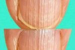 Rippled fingernails reveal secrets of possible disease