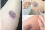 BE CAREFUL, if you get these bruises on your body, it means you have Ca…