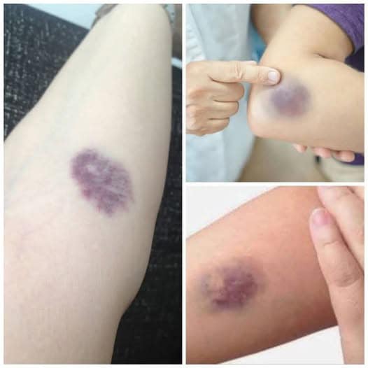 BE CAREFUL, if you get these bruises on your body, it means you have Ca…