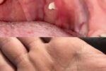 Why do we have white lumps in our throat?