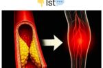Doctors Warn: 10 Silent Signs Your Leg Arteries Are Clogged