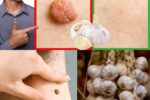 Say Goodbye to Skin Tags—Naturally and Safely!