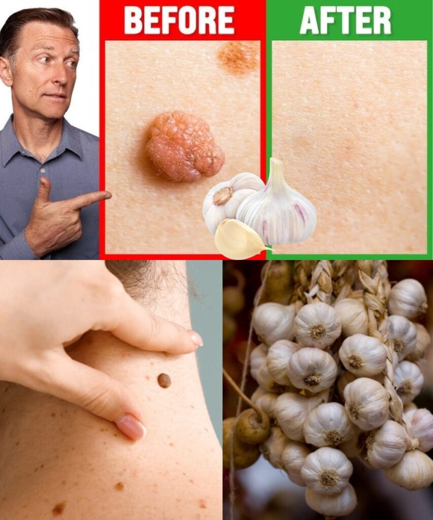 Say Goodbye to Skin Tags—Naturally and Safely!