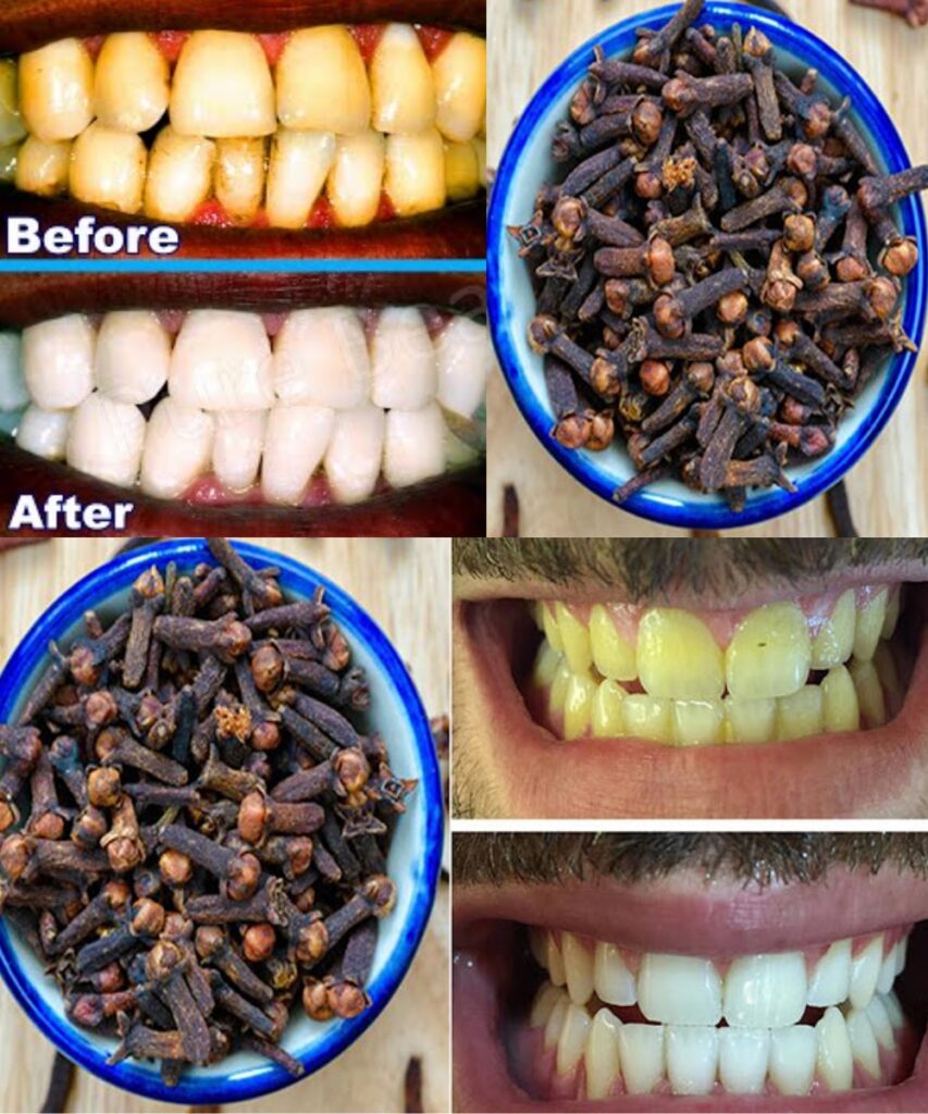 Chewing Cloves Daily: The Tiny Spice with Big Oral Health Benefits