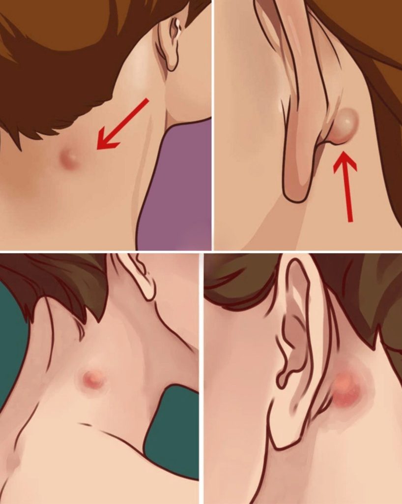 What That Swollen Lump Near Your Neck or Ear Really Means – And When to Worry