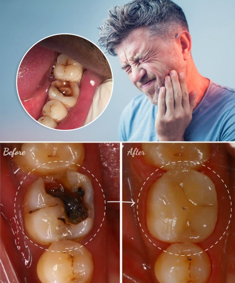 Simple Natural Tips to Keep Your Teeth Healthy – Avoid Extra Dental Visits with These 5 Natural Cavity Remedies