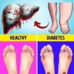 👣 12 Subtle Signs in Your Feet That Could Point to Liver Trouble (Don’t Ignore These!)
