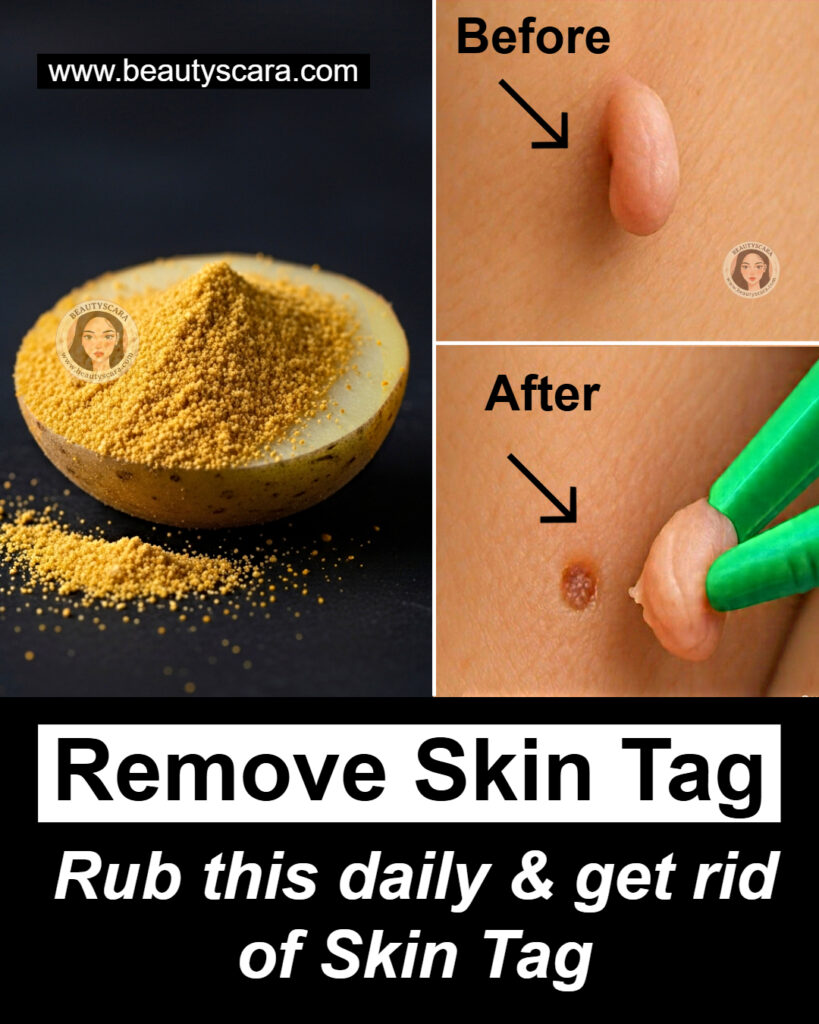 3 Home Remedies to get rid of Skin Tags – Skin Tag Removal