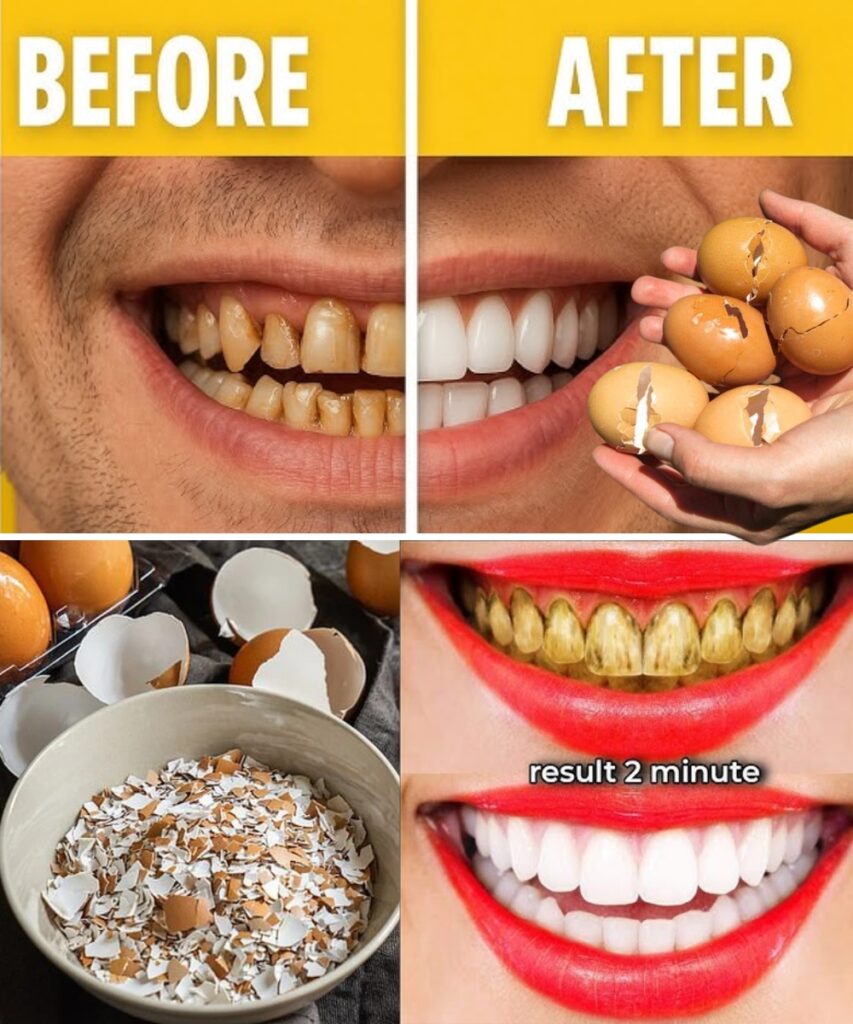After 5 Minutes the Yellow Color of the Teeth Becomes Pearl White